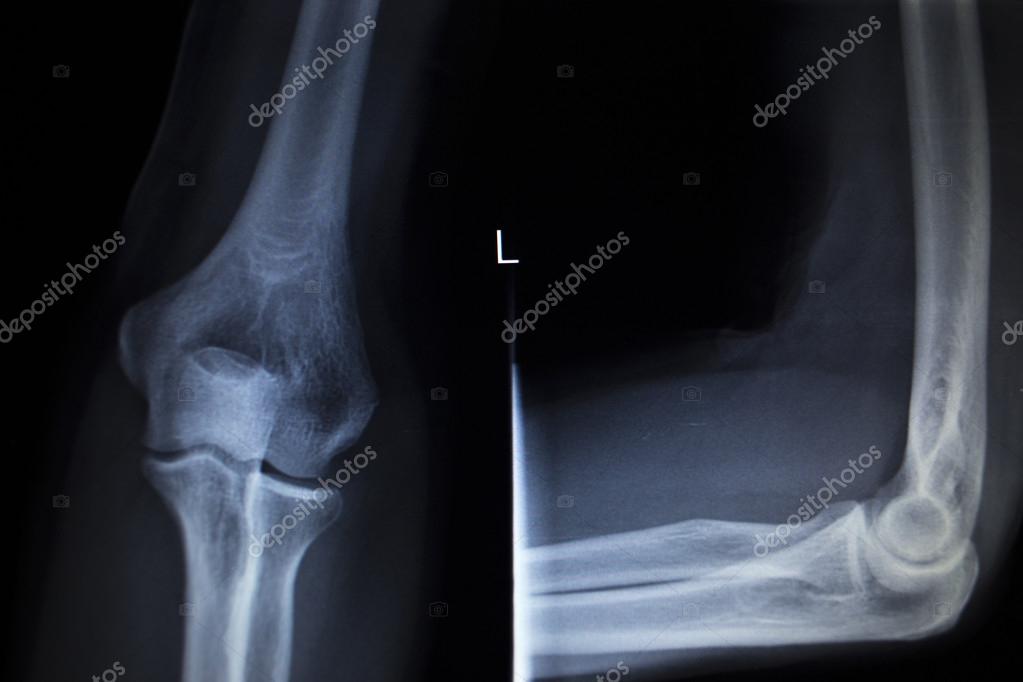 Tennis Elbow X Ray