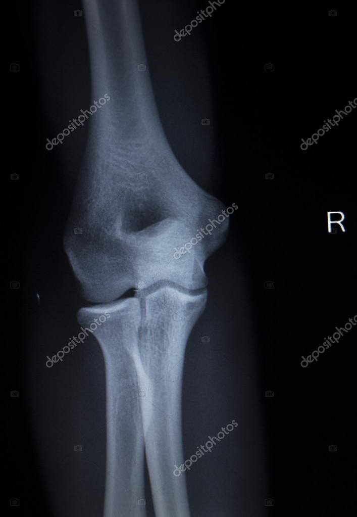 Xray orthopedics Traumatology scan of elbow joint injury — Stock Photo