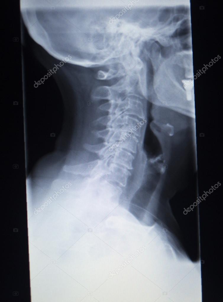 Radiografia ortopédica Traumatologia da lesão cervical fotos, imagens de ©  edwardolive #74476669