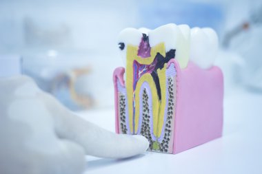 Dental tooth model cast showing decay enamel roots clipart