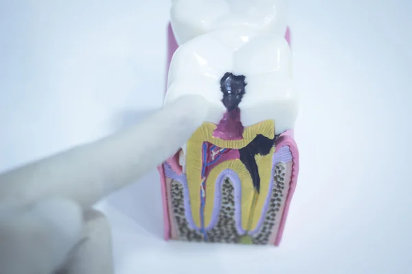 Tandheelkundige tand model gegoten verval glazuur wortels te laten zien — Stockfoto