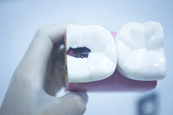 Dental tooth model cast showing decay enamel roots — Stock Photo, Image