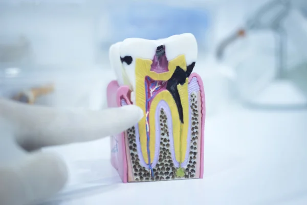 Modelo de diente dental fundido mostrando raíces de esmalte de caries — Foto de Stock