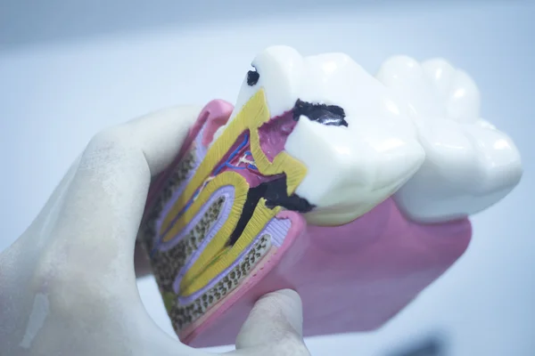 diş diş modeli gösteren çürüme emaye kökleri döküm