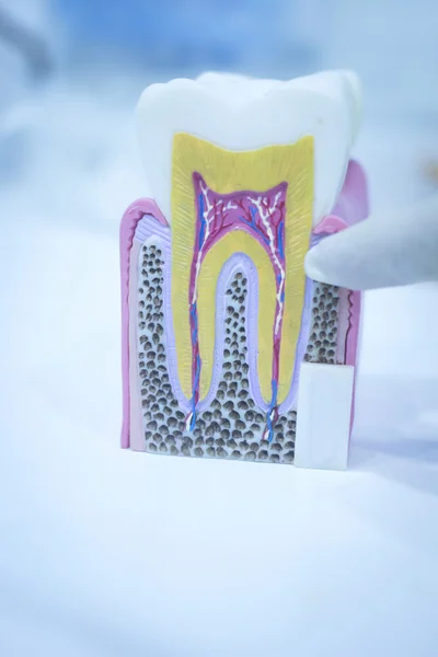 Οδοντιατρική δόντι cast μοντέλο δείχνει φθορά σμάλτο ρίζες — Φωτογραφία Αρχείου