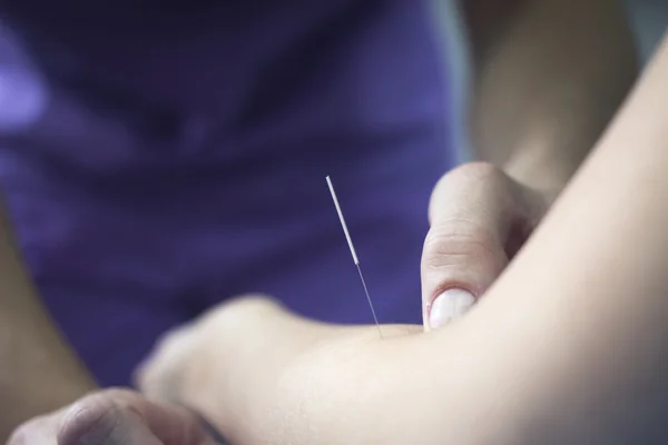 Braço do paciente da agulha da acupuntura da mão do doutor — Fotografia de Stock
