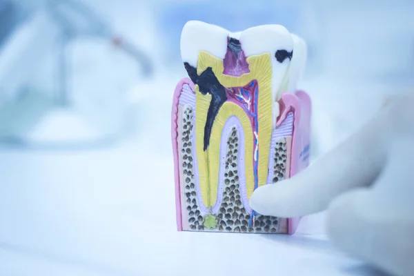 Dental tooth model cast showing decay enamel roots — Stock Photo, Image