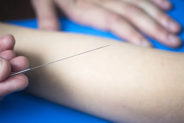 Médico mano acupuntura aguja paciente brazo —  Fotos de Stock