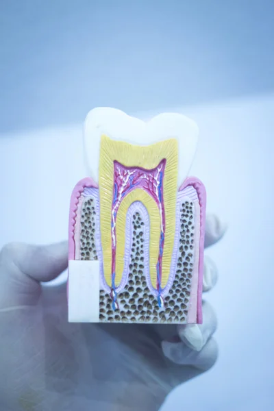 Zubní zubní modelu obsazení ukazující kazu skloviny kořeny — Stock fotografie