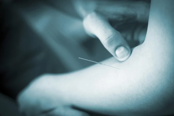 Braço do paciente da agulha da acupuntura da mão do doutor — Fotografia de Stock