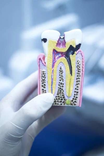 Dental tooth model cast showing decay enamel roots — Stock Photo, Image