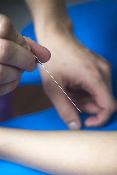 Doktor el akupunktur iğnesi hastanın kol — Stok fotoğraf