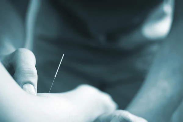 Médico mano acupuntura aguja paciente brazo — Foto de Stock