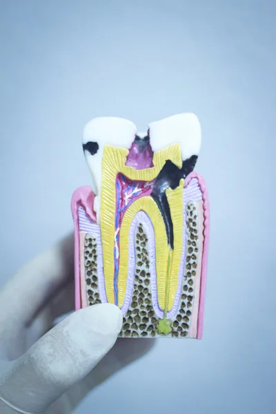 Dental tooth model cast showing decay enamel roots