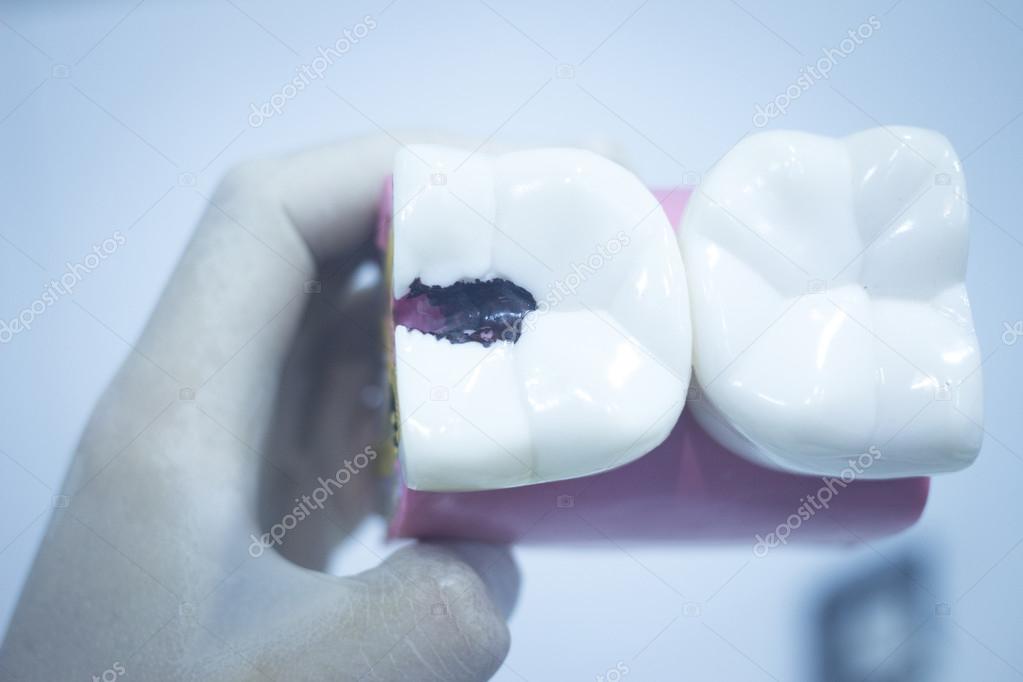 Dental tooth model cast showing decay enamel roots