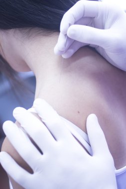 Doctor hand acupuncture needle dry needling