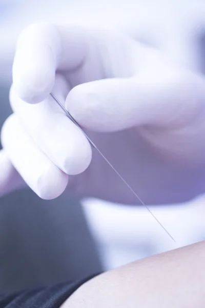 Doctor hand acupuncture needle dry needling — Stock Photo, Image