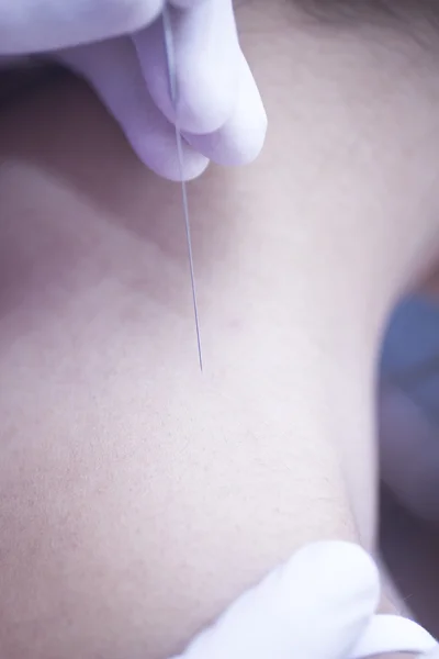 Doctor hand acupuncture needle dry needling — 스톡 사진