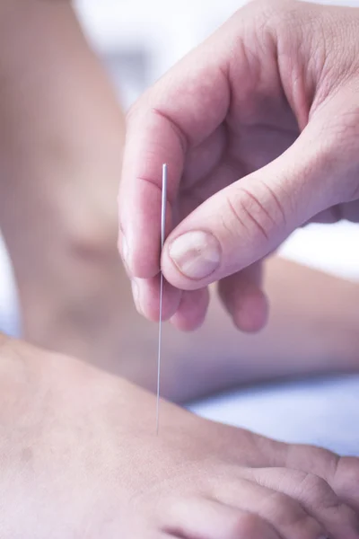 Doctor hand acupuncture needle dry needling — Stock fotografie