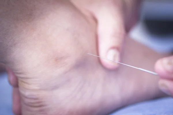Doctor hand acupuncture needle dry needling