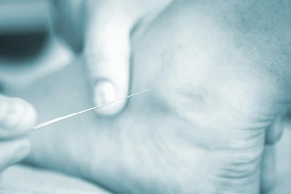 Doctor hand acupuncture needle dry needling — Stock fotografie