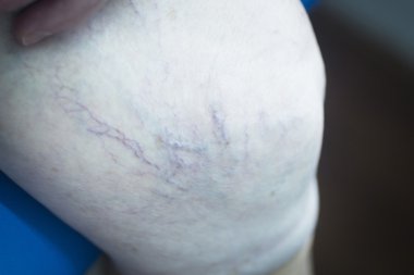 Fizik tedavi fizik tedavi hasta bacak