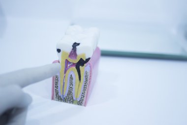 diş diş modeli gösteren çürüme emaye kökleri döküm