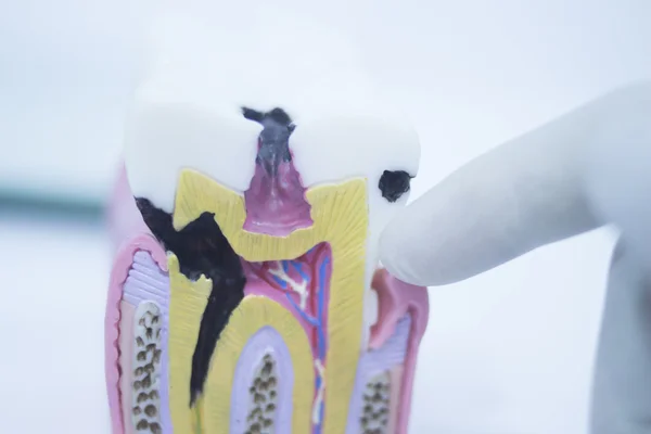 Dental tooth model cast showing decay enamel roots — Stock Photo, Image