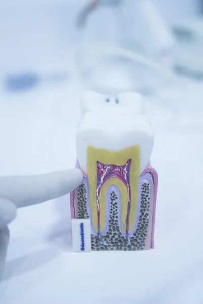 Dental tooth model cast showing decay enamel roots — Stock Photo, Image