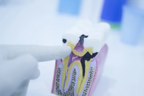 Dental tooth model cast showing decay enamel roots — Stock Photo, Image