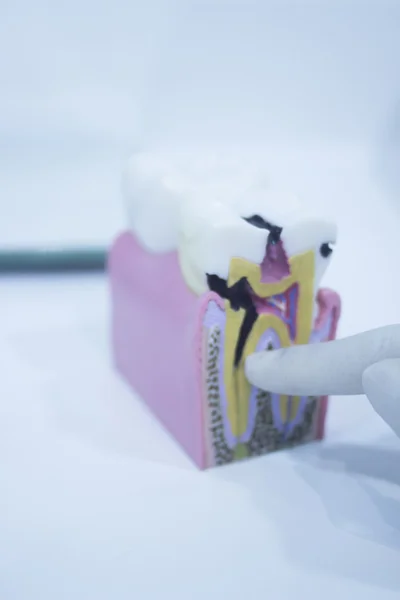 Литой зубной протез с эмалевыми корнями — стоковое фото