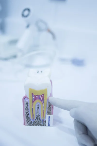 Zahnmodellabguss mit Karies-Zahnschmelzwurzeln — Stockfoto