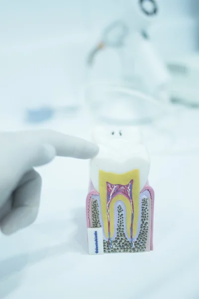 Dental tooth model cast showing decay enamel roots — Stock Photo, Image