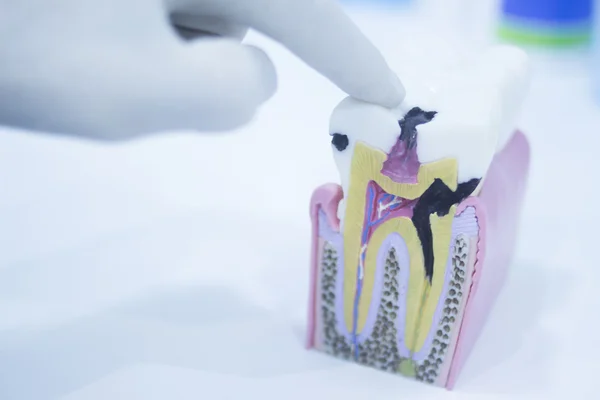 Modelo de diente dental fundido mostrando raíces de esmalte de caries — Foto de Stock