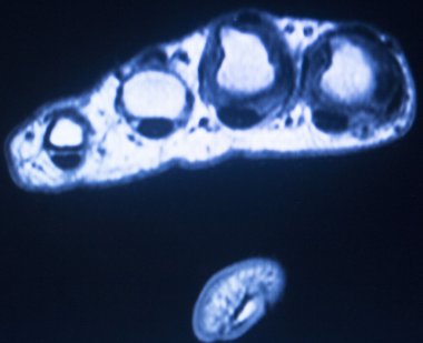 Mr manyetik rezonans görüntüleme el parmaklarında inceden inceye gözden geçirmek 