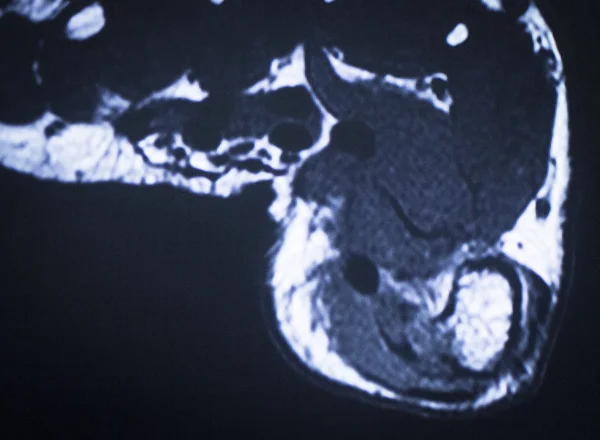 МРТ магнітно-резонансна томографія пальців ніг сканування — стокове фото