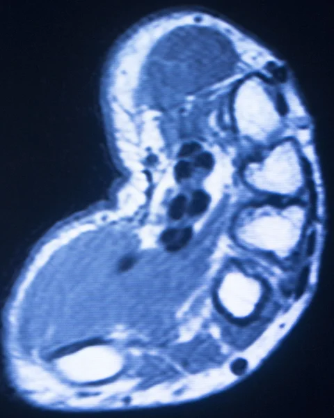 Resonancia magnética por resonancia magnética escaneo de los dedos — Foto de Stock