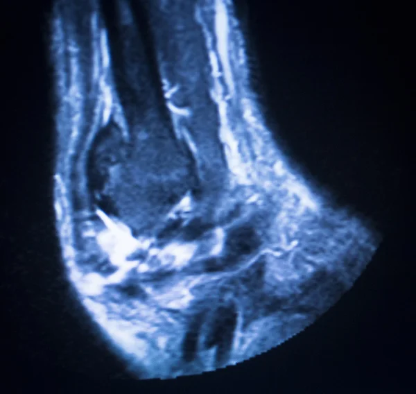 Ressonância magnética RM tornozelo varredura — Fotografia de Stock