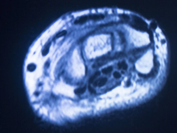Pencitraan resonansi magnetik MRI jari tangan — Stok Foto