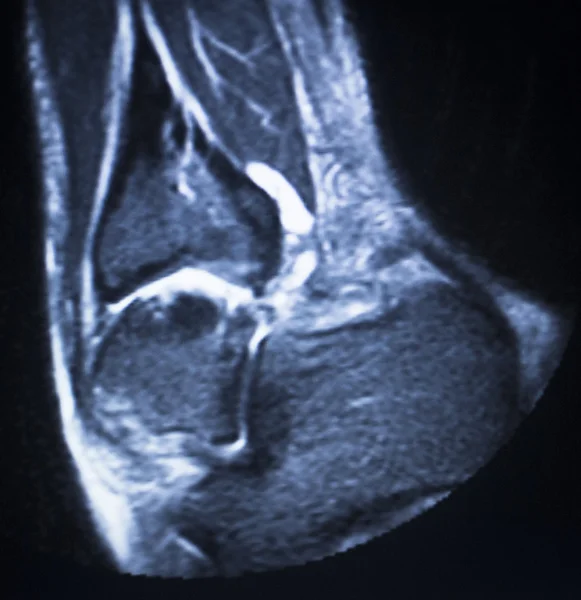 Mri 磁共振成像踝关节扫描 — 图库照片