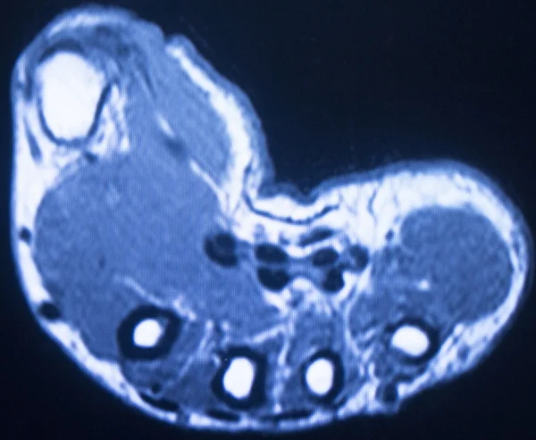 Mri 자기 공명 영상 손 손가락 스캔 — 스톡 사진