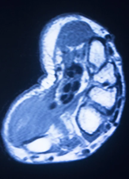Ressonância magnética MRI mão dedos digitalizar — Fotografia de Stock
