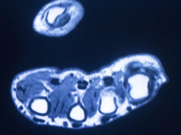 Ressonância magnética MRI mão dedos digitalizar — Fotografia de Stock