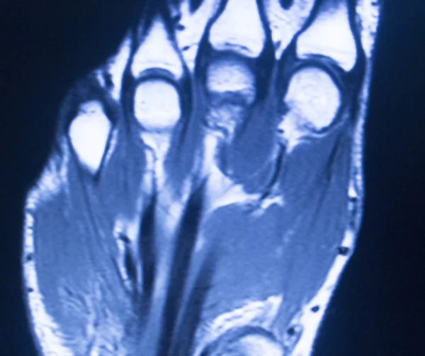 Mri Magnetresonanztomographie Hand Finger-Scan — Stockfoto