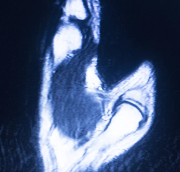 Ressonância magnética RM mão carpal scan — Fotografia de Stock