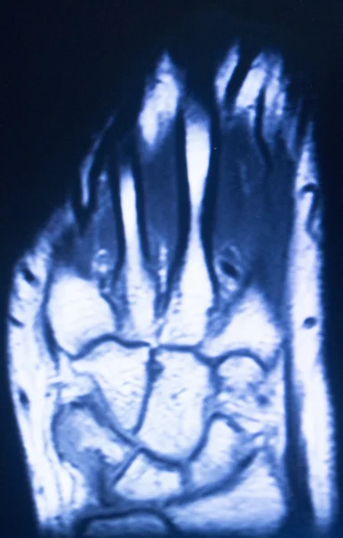 MRI magnetic resonance imaging hand finger scan — Stock Photo, Image