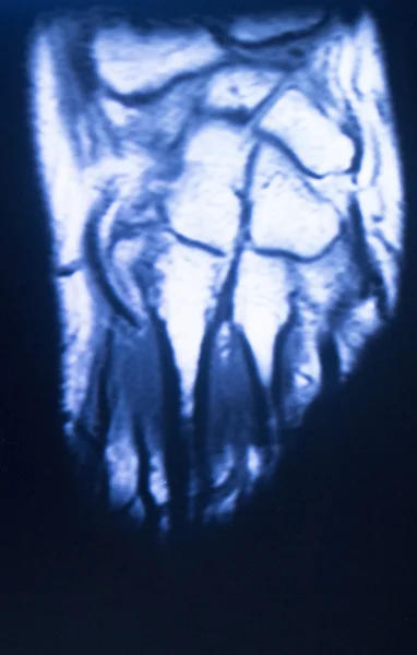 MRI-scan in de vinger magnetische resonantie beeldvorming hand — Stockfoto