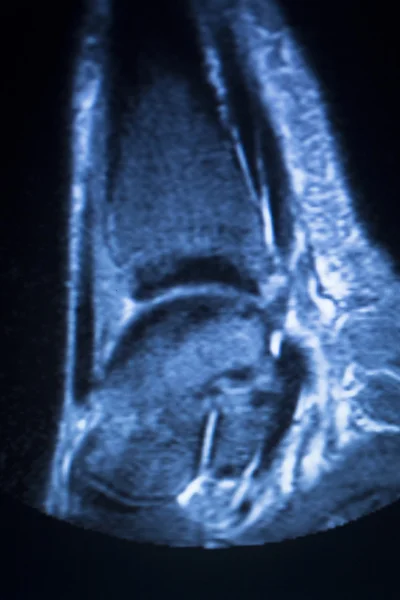 Mri Magnetresonanztomographie Knöchel-Scan — Stockfoto