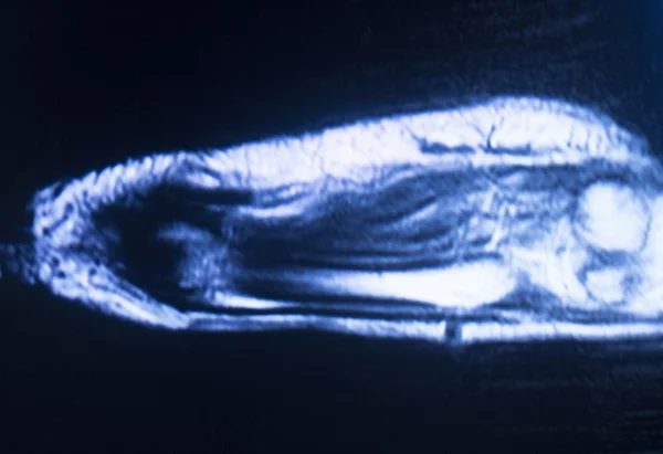 Ressonância magnética RM mão carpal scan — Fotografia de Stock