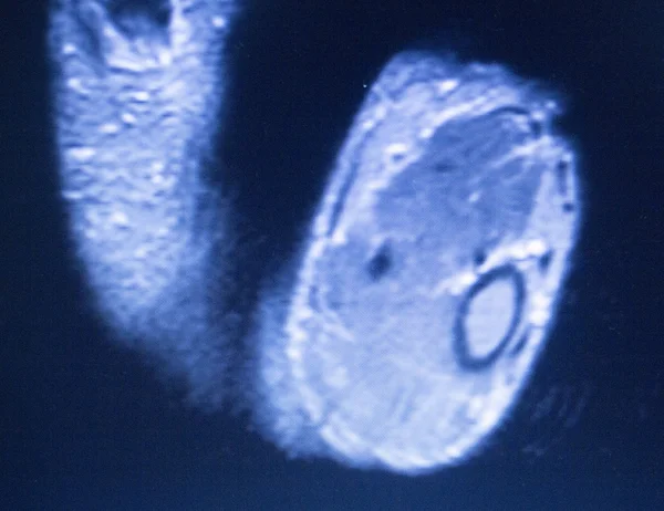 MRI magnetresonanstomografi hand finger scan — Stockfoto